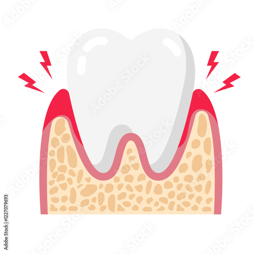 dental gingivitis