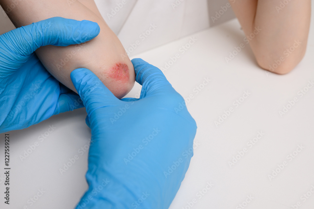 Doctor carefully examines child's elbow at reception, with inflamed red areas of skin. Child suffers from attacks of allergies and dermatitis. Dermatological skin diseases, care of children's skin Doctor carefully examines child's elbow at reception, with inflamed red areas of skin. Child suffers from attacks of allergies and dermatitis. Dermatological skin diseases, care of children's skin