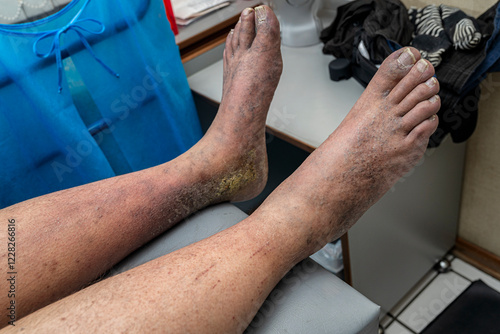 Medical themes: Female patient with venous insufficiency in her legs.