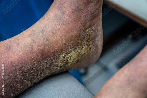 Medical themes: Female patient with venous insufficiency in her foot.