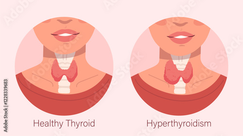 Healthy vs. Hyperthyroidism. Vector illustration