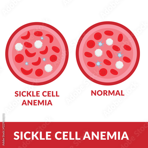 Sickle cell disease. The difference of Normal red blood cell and sickle cell
