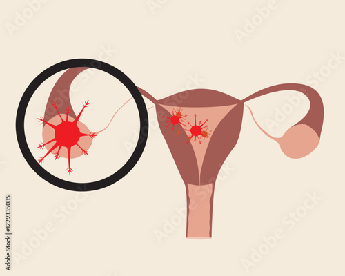 Isolated uterus with malignant tumor as oncology concept, flat vector stock illustration as cervical cancer or ovarian cancer