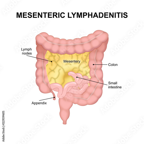 Mesenteric lymphadenitis Illustration lymph node photo