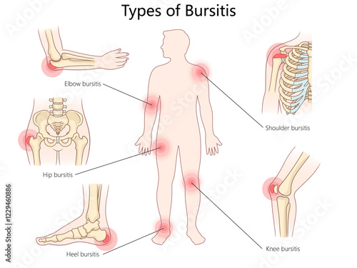 bursitis types, including elbow, shoulder, hip, knee, and heel, with inflamed bursae locations diagram hand drawn schematic vector illustration. Medical science educational illustration