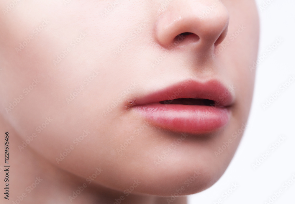 Obraz premium Woman showing herpes disease on her lips. Treatment of viral infections.