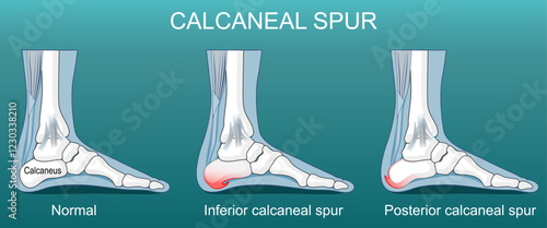 Calcaneal spur. Osteophytes on the posterior and inferior aspects of the calcaneus.