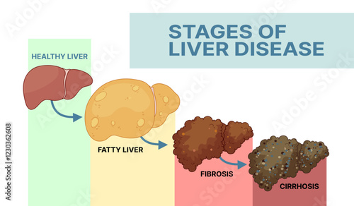 Stages of liver disease. Рealthcare illustration. Medical infographic. Vector illustration. 