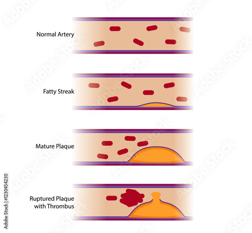 Stages of coronary artery disease with a normal artery, a fatty streak, mature plaque, and ruptured plaque with thrombosis