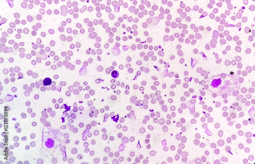 Peripheral blood smea, the red blood cells (RBCs) show anisocytosis, poikilocytosis, hypochromia and target cells may be due to the Iron deficiency anemia, Thalassemia or Liver disease. photo