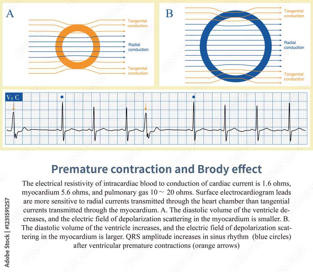 Fotografie When premature contractions occur, the ventricular filling time is shortened and the ventricular filling volume decreases, which can lead to a decrease in QRS wave amplitude