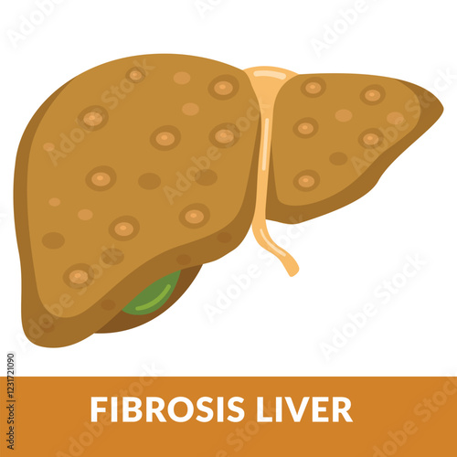 Illustration of Liver Disease Fibrosis