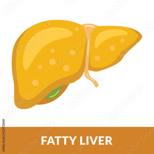 illustration of a liver organ full of fat. Fatty liver disease or hepatic steatosis