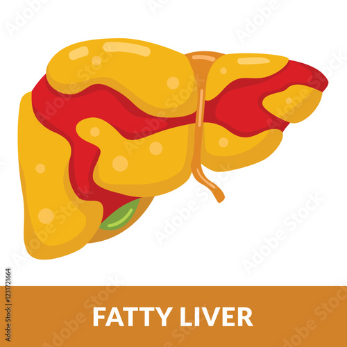 illustration of a liver organ full of fat. Fatty liver disease or hepatic steatosis