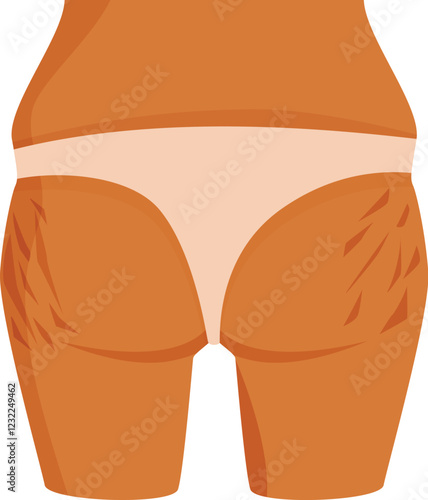 Stretch marks on woman buttocks and thighs, body care and skin problem concept