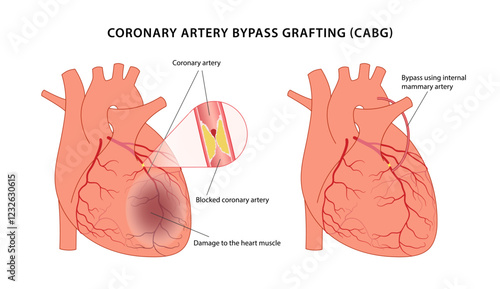 Coronary artery bypass grafting (CABG). Medical illustration of bypass surgery of a diseased heart using the internal mammary artery. Vector illustration in a flat style