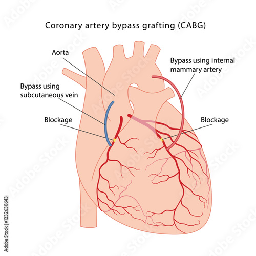 Coronary artery bypass grafting (CABG). Medical illustration of bypass surgery of a diseased heart using the internal mammary artery and the vein of the lower leg. Vector illustration in a flat style