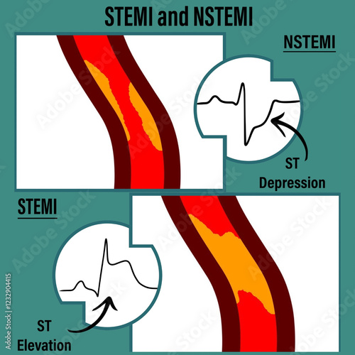 Canvastavla STEMI vs