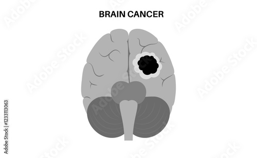 Brain cancer poster