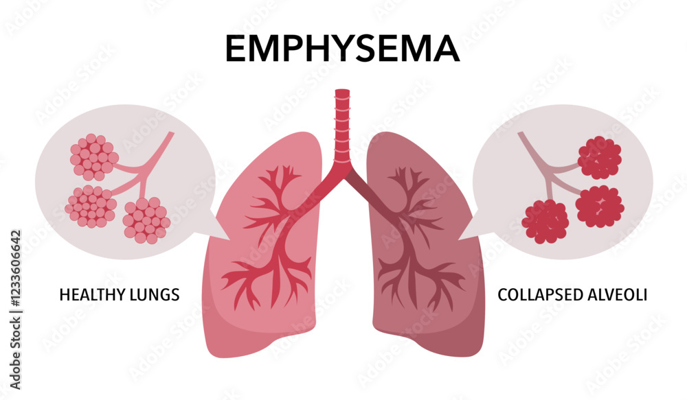 Obraz premium Emphysema disease concept. Damaged alveoli, failure airway. Floppy walls between air sacs in human lungs. Shortness of breath, chest tightness. Illness of respiratory system flat vector illustration