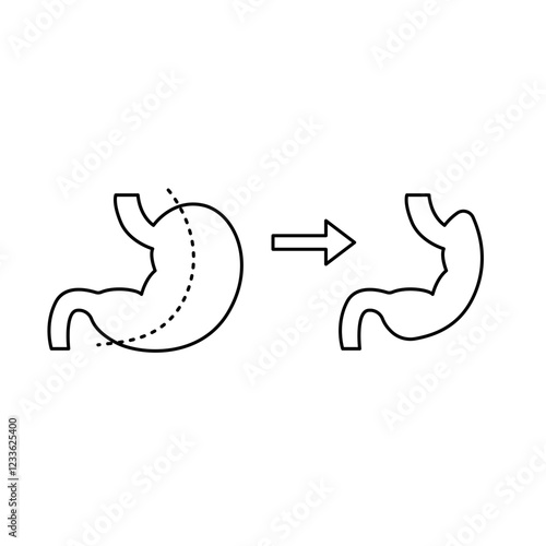 Gastrectomy