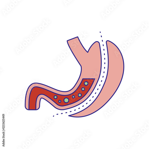 Gastrectomy illustration
