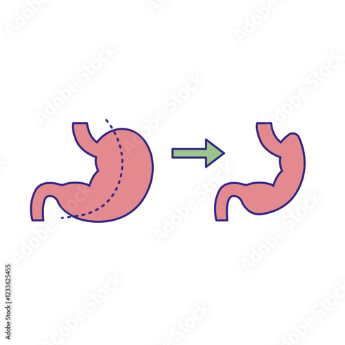 Gastrectomy illustration