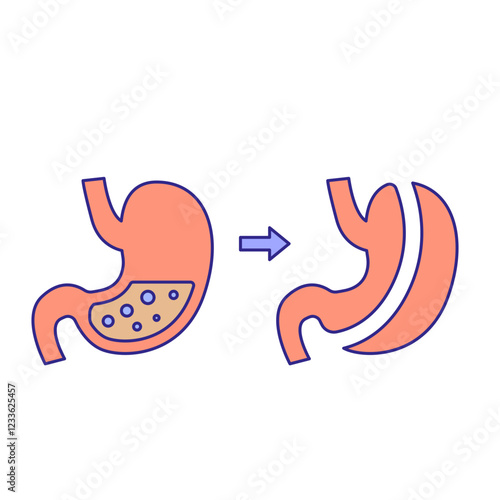 Gastrectomy illustration