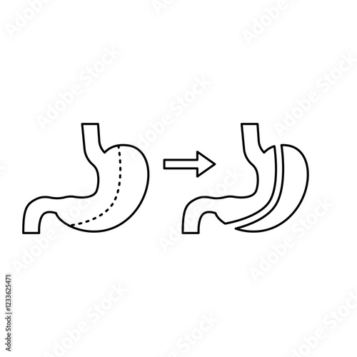 Gastrectomy