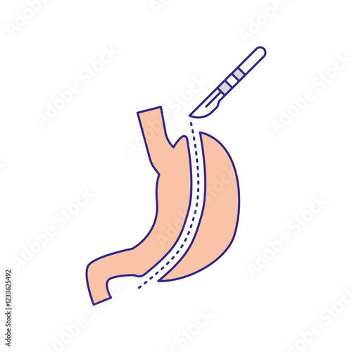 Gastrectomy illustration