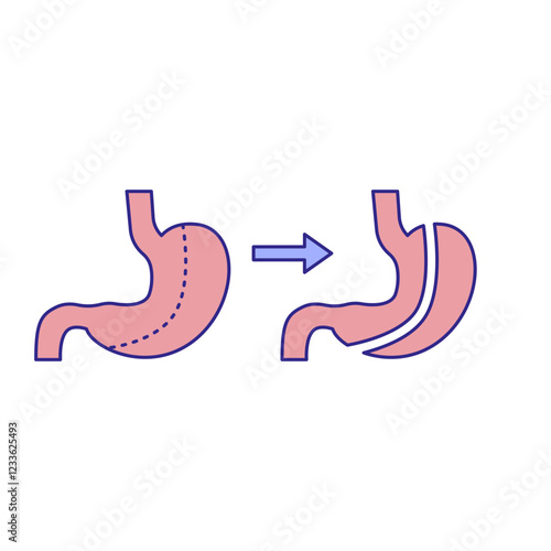 Gastrectomy illustration