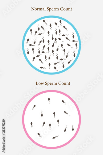 normal and low sperm count illustration. Male infertility oligospermia. Structure of the sperm.