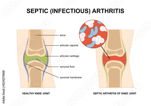 Infectious (septic) arthritis of knee illustration