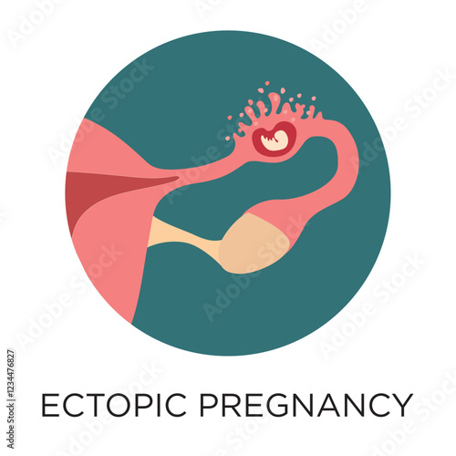 Vector Ectopic Pregnancy Icon