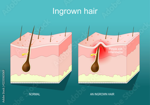 Ingrown hair. Close-up of a hair follicle. Cross section of human skin