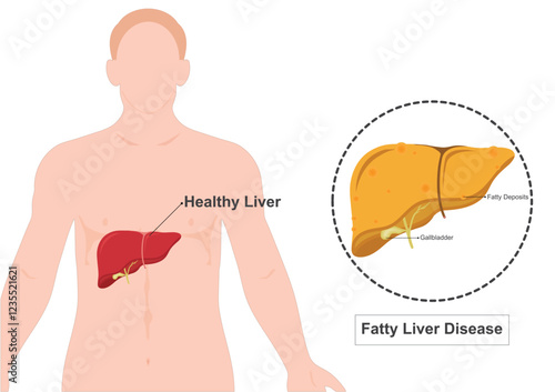 Fatty liver disease is a condition.