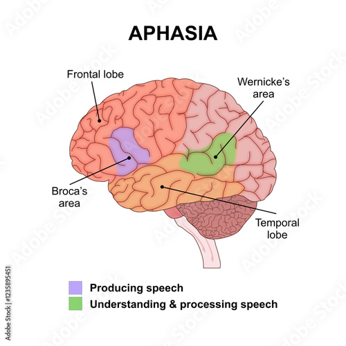 Aphasia language disorder brain illustration