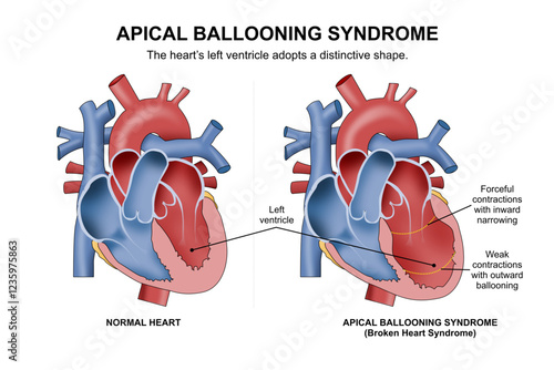 Apical Ballooning Syndrome (Broken heart Syndrome) Illustration