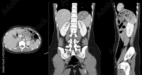 Contrast-enhanced CT whole abdomen study revealing normal anatomical structures, with no signs of pathology or abnormal fluid accumulation. photo