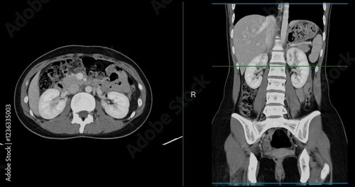 Contrast-enhanced CT whole abdomen study revealing normal anatomical structures, with no signs of pathology or abnormal fluid accumulation.