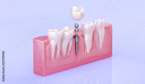 Dental teeth implant. Placement of a titanium implant into the jawbone to replace a missing tooth. Implant fixture, abutment, dental crown. Oral surgery, veneers, dentistry, oral prosthesis medical 3D photo