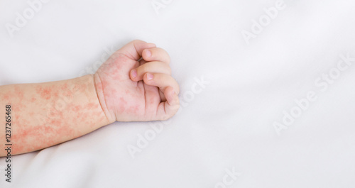 Cuadro en lienzo Hand of newborn baby with measles rash on white sheet, closeup, panorama with fr