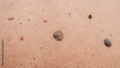 Tableau sur toile Moles and birthmarks on human skin close-up.