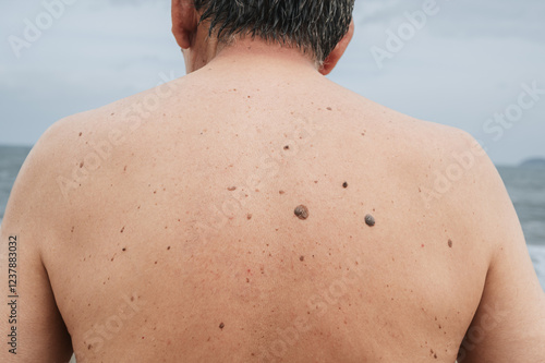 Foto The back of an elderly man with freckles, aging spots, black, brown warts and wrinkles