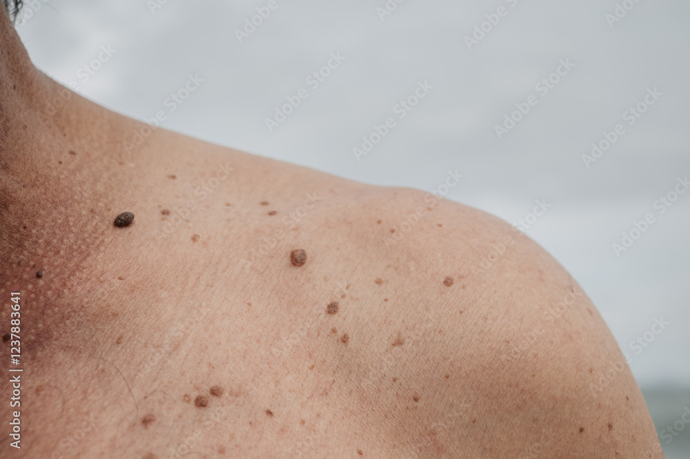 custom made wallpaper toronto digitalSkin texture black birthmarks and moles on the skin of an elderly man