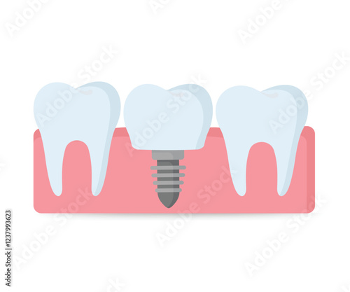 Dental implantation tooth restoration Vector illustration stock illustration