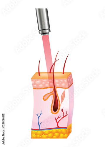 Laser hair removal procedure with concentrated beam of light on the skin. Skin layers, laser affects on body hair. Face hair removal icon for cosmetology or skincare. Medical science concept