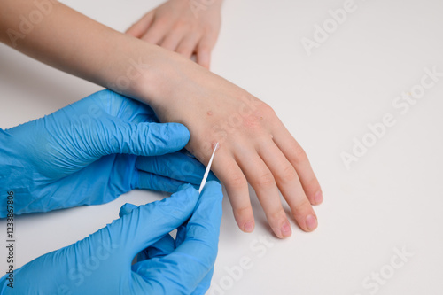 Foto Doctor applies wart remover with applicator to child's hand and examines skin damaged by viral warts Verruca vulgaris