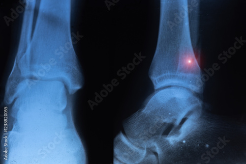 Obraz na płótnie X-ray scan of a brokening fibula bone.