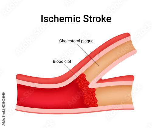 Causes and Symptoms Ischemia Stroke